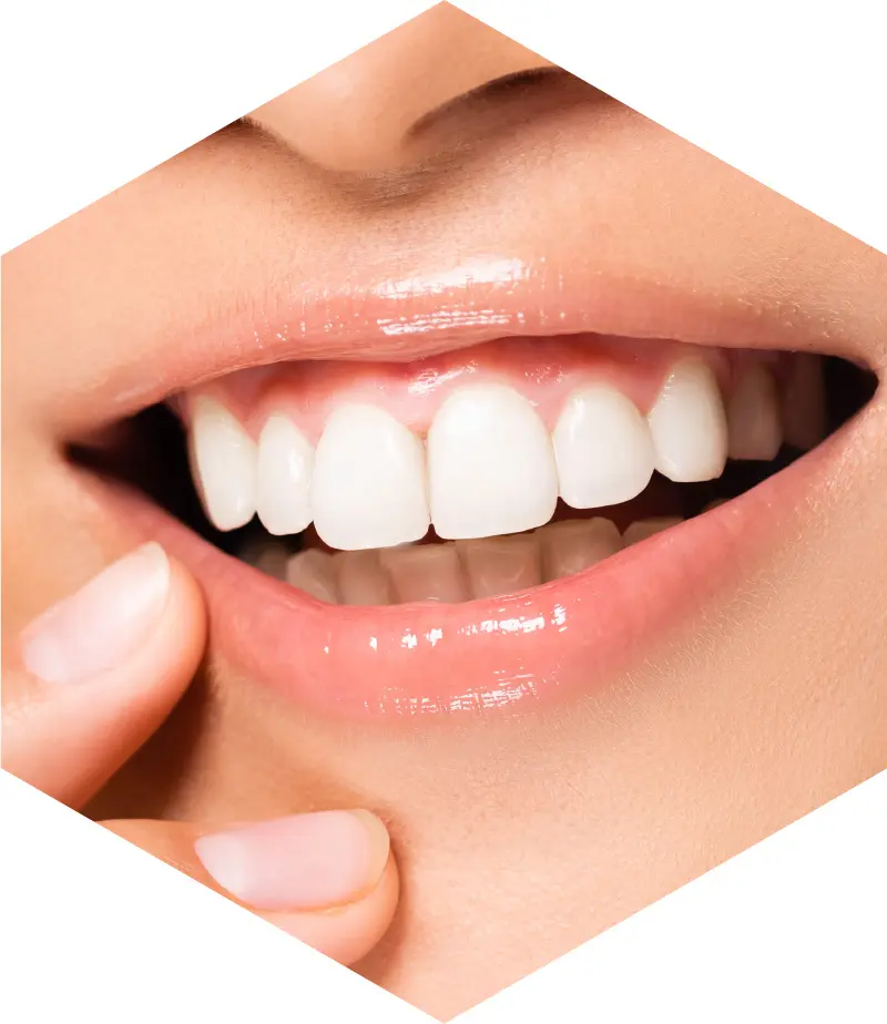 漾美學牙醫 1 one day veneer img1