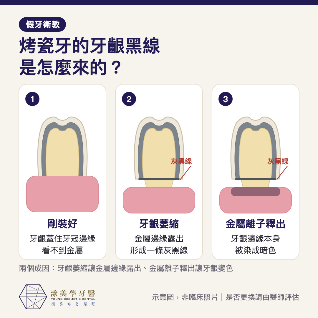烤瓷牙牙齦黑線成因示意圖：剛裝好、牙齦萎縮露出金屬邊緣、金屬離子釋出讓牙齦變色三個階段