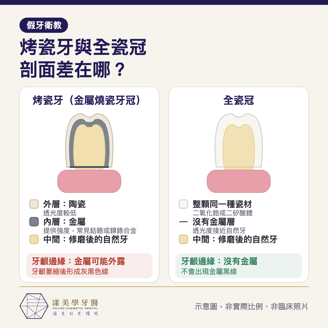 烤瓷牙與全瓷冠剖面結構示意圖：烤瓷牙為金屬內層加陶瓷外層，全瓷冠整顆同一種瓷材